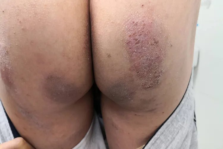 过敏性皮炎图片和症状