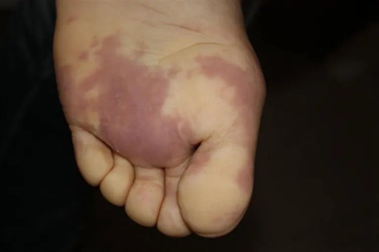 脚上突然红了一块图片