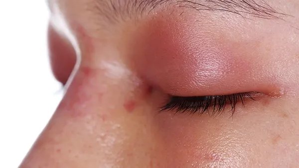 透明质酸注射隆鼻安全 但容易反弹