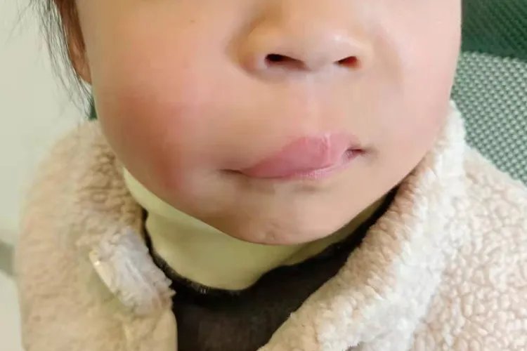 过敏性皮炎图片和症状