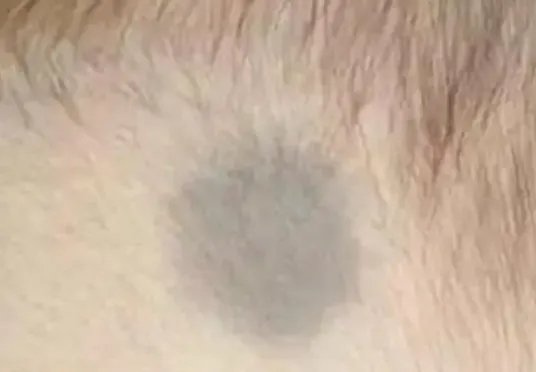 湖南双胞胎在肚子里打架出生后浑身淤青，宝宝出生时的淤青是怎样形成的？