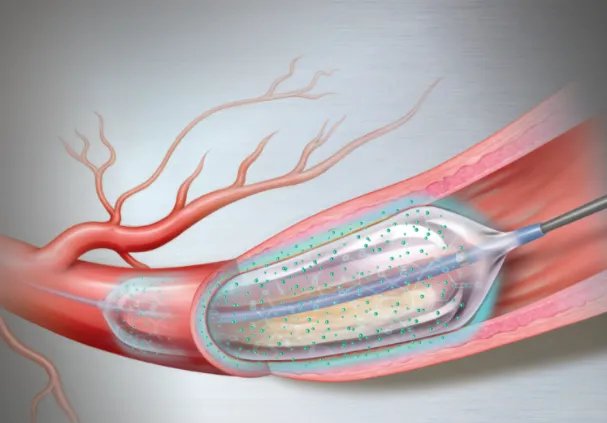 心脏支架降价后,医生开始滥用药物球囊?球囊会替代支架吗?