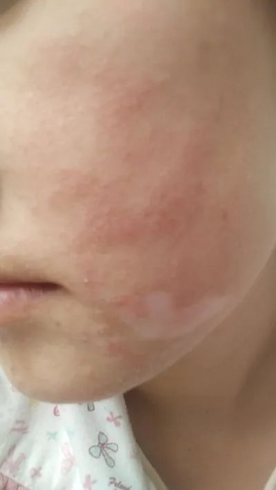 过敏性湿疹症状?