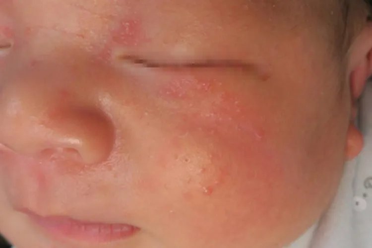 新生儿湿疹症状图片大全