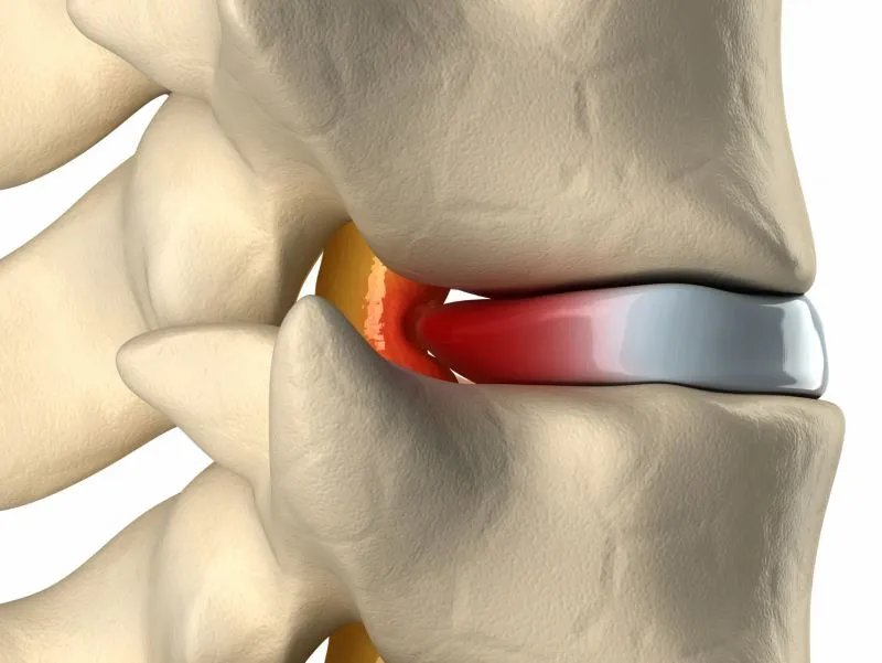 颈椎病的自我治疗体操