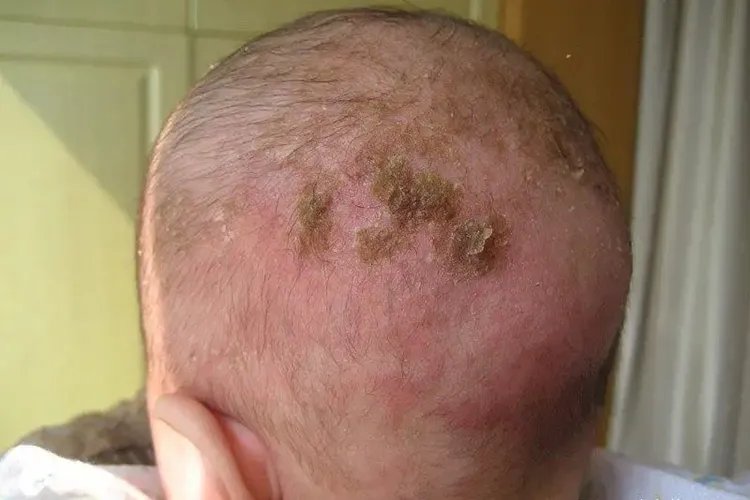 新生儿湿疹症状图片大全