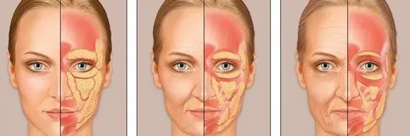 传统拉皮可以维持多久