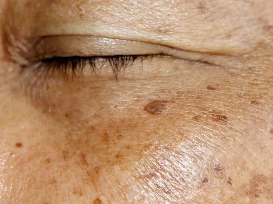 如何祛除老年斑