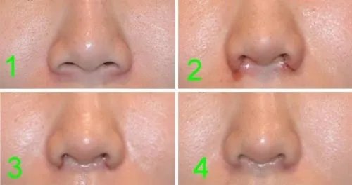 鼻孔整形术多少钱