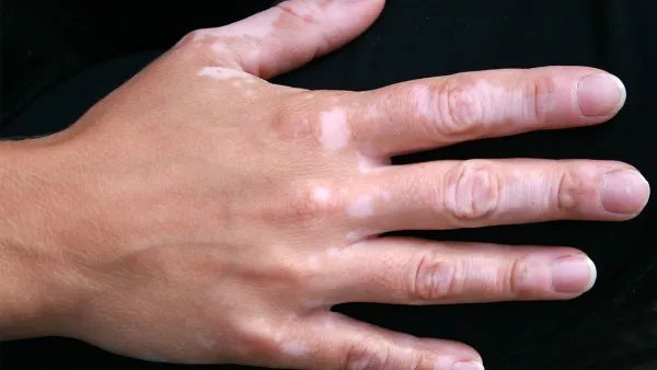 手上有老年斑怎么办