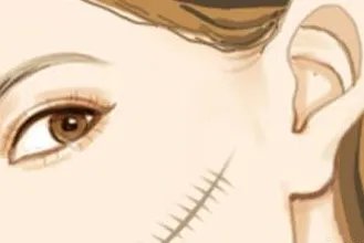 传统拉皮可以维持多久