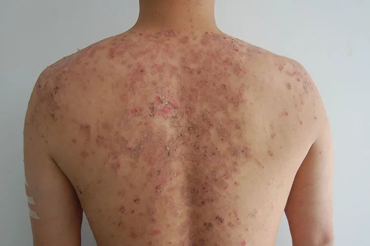 过敏性皮炎图片和症状