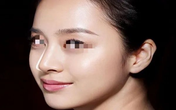 玻尿酸隆鼻需要多少钱？