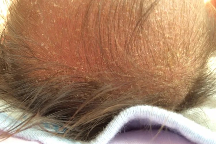 新生儿湿疹症状图片大全