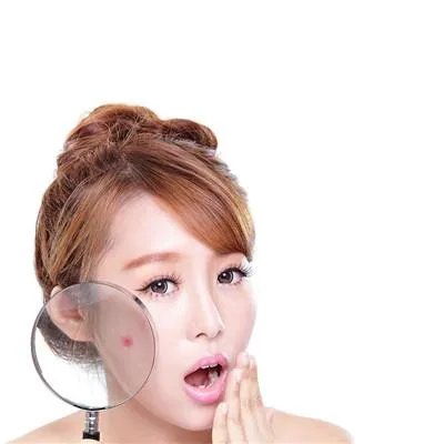 无色素痣是怎么回事?