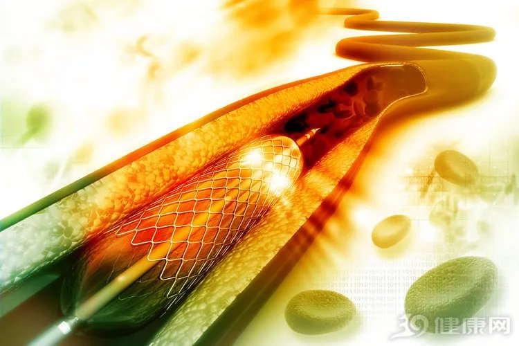 心脏支架降价后,医生开始滥用药物球囊?球囊会替代支架吗?