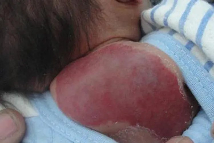 血管瘤长瘤图片