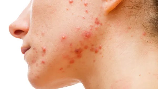 下巴长痤疮怎么办