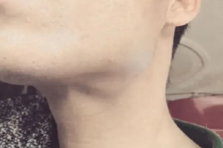 鼻疖颈部肿块图片