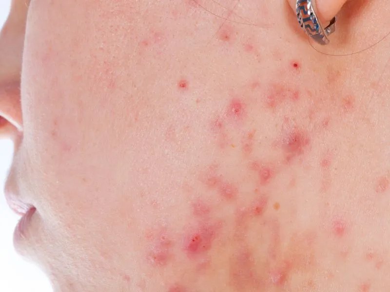 去痘坑的方法有什么