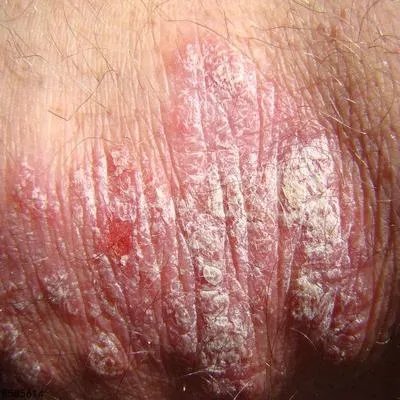 寻常型银屑病治疗费用大概需要多少