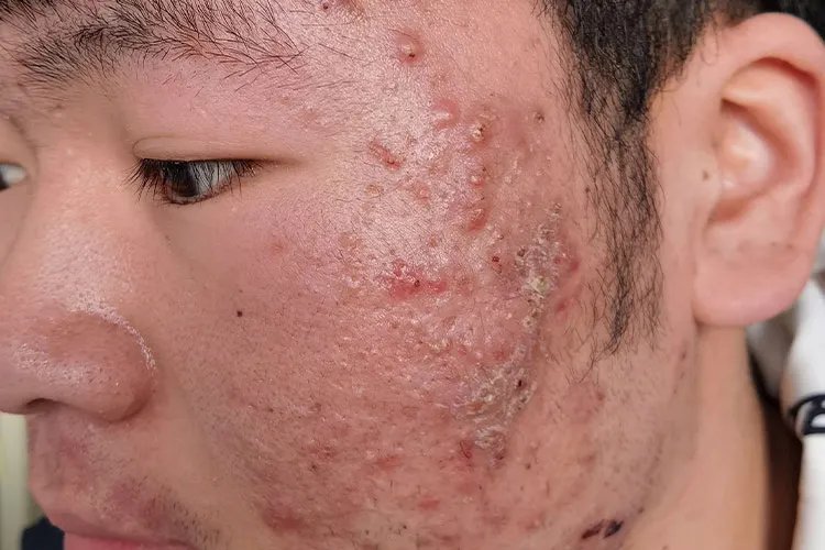 起痘痘的位置对照内脏