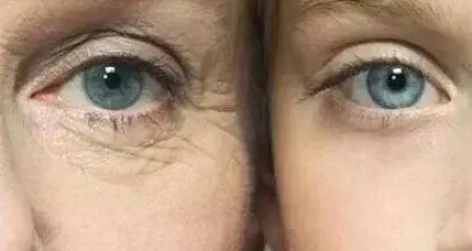 传统拉皮可以维持多久