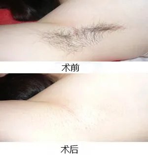 冰点激光脱毛价格是多少