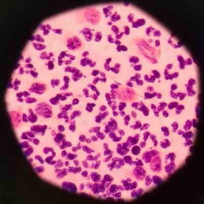 妇科炎症真菌感染要怎么办