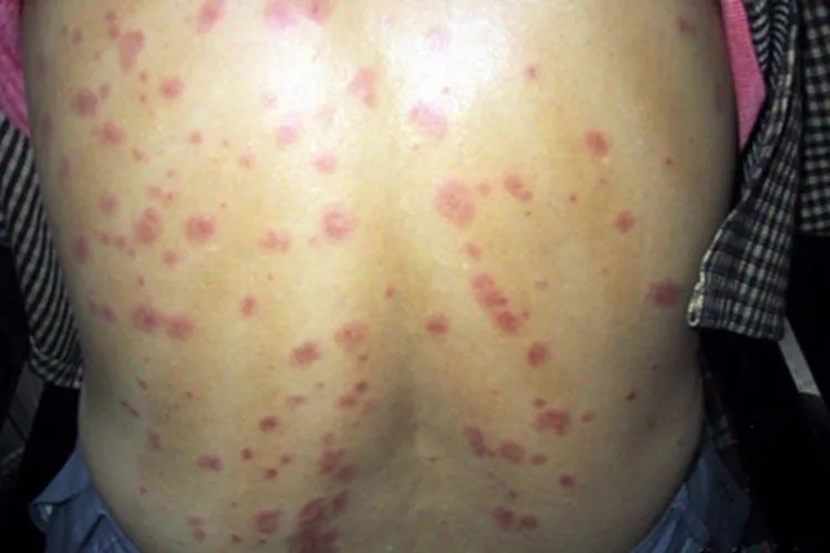 多形红斑背部症状图片