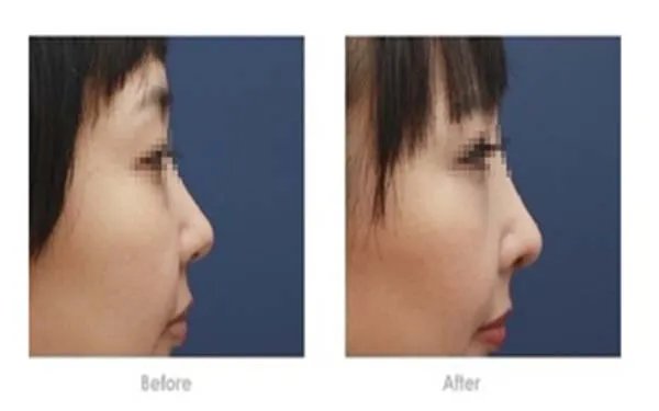 东莞硅胶隆鼻手术整形医院哪里好_知名硅胶隆鼻手术美容整形医院有哪些【附价格】