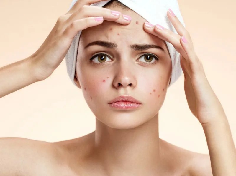 嘴周围长痘痘的原因