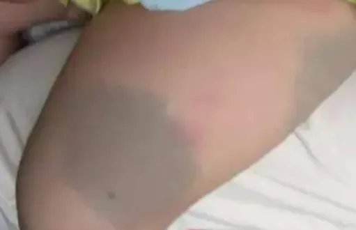 湖南双胞胎在肚子里打架出生后浑身淤青，宝宝出生时的淤青是怎样形成的？