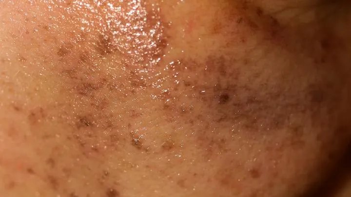 结肠黑变病饮食需要注意什么？