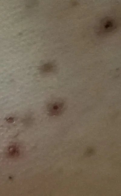 过敏性湿疹症状?