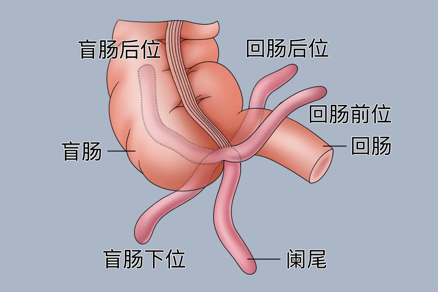 阑尾的位置图片