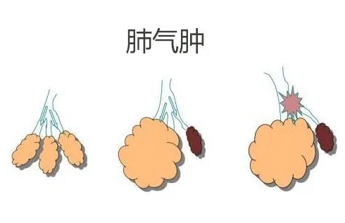 演员张少华因慢阻肺去世，此病有哪些明显的体征？