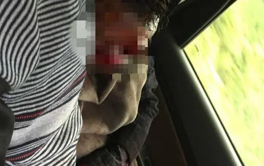 村民寻药遭黑熊袭击有人受伤吗？