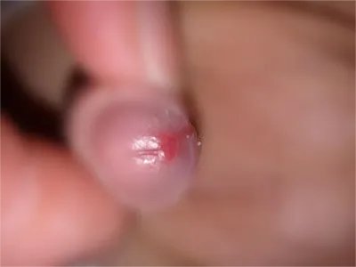 生殖道衣原体感染龟头红斑图片