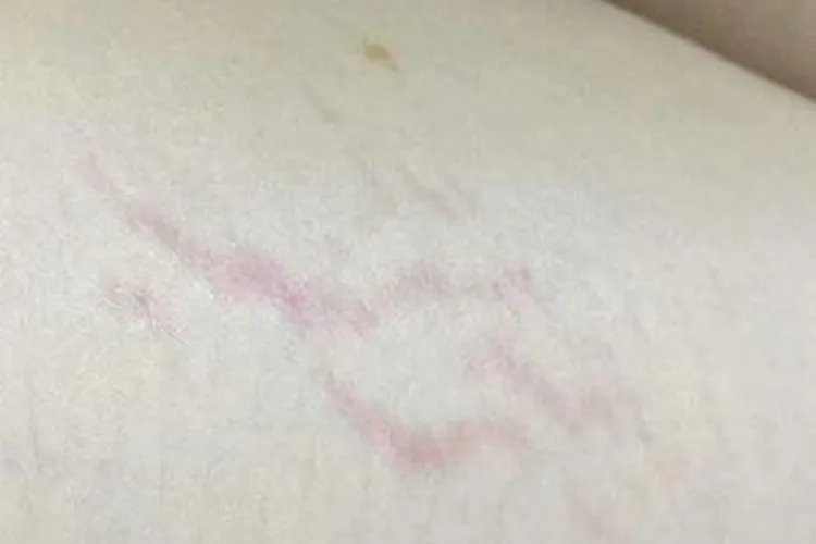 肥胖纹初期图片