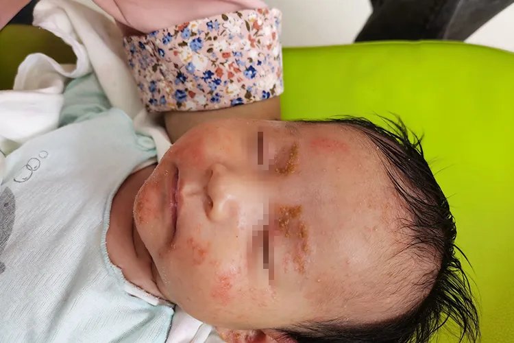 新生儿湿疹症状图片大全