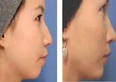 玻尿酸隆鼻价格是多少钱