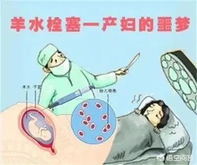 网曝刘强东妹妹因羊水栓塞去世,作为产妇“致命恶魔”的它到底有多可怕?