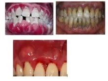 刷牙之后还口臭，到底是什么惹的祸