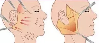 传统拉皮可以维持多久