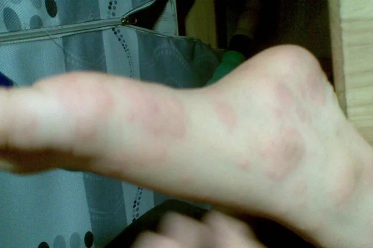 脚上突然红了一块图片