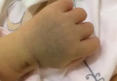 湖南双胞胎在肚子里打架出生后浑身淤青，宝宝出生时的淤青是怎样形成的？