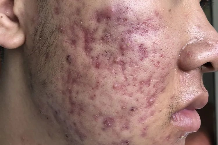 起痘痘的位置对照内脏