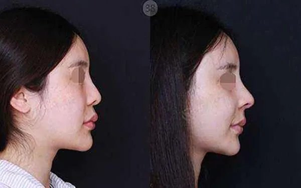 上海玻尿酸隆鼻哪家整形医院好