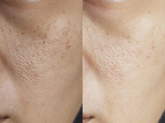 祛痘美白小窍门